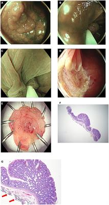 Modified underwater endoscopic mucosal resection for intermediate-sized sessile colorectal polyps